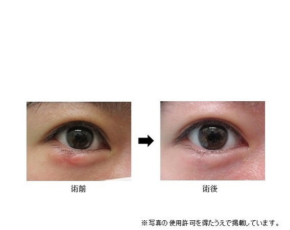 ものもらい 霰粒腫 | 霰粒腫 温める 治った – DentalCoalition